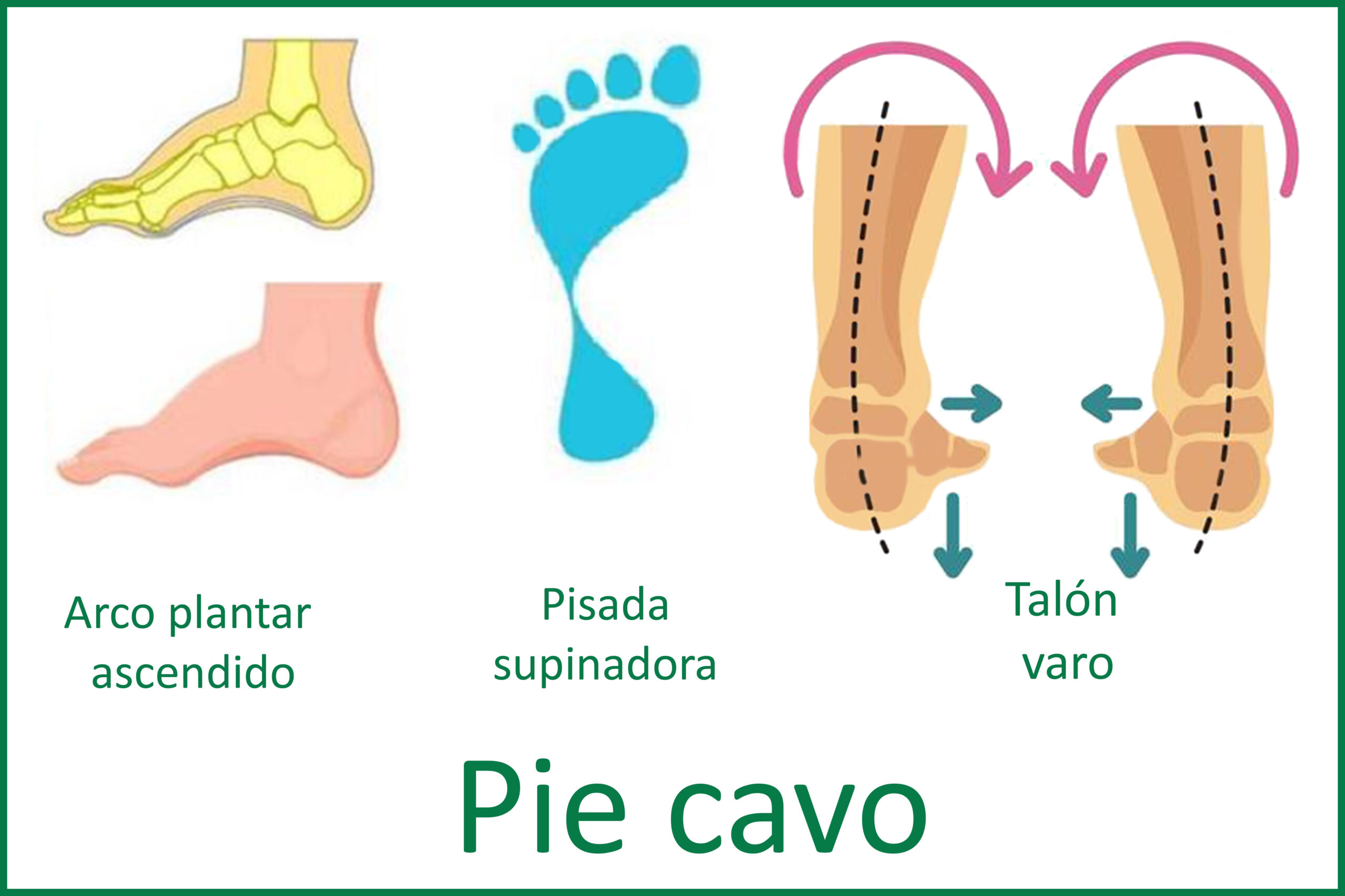 pie cavo